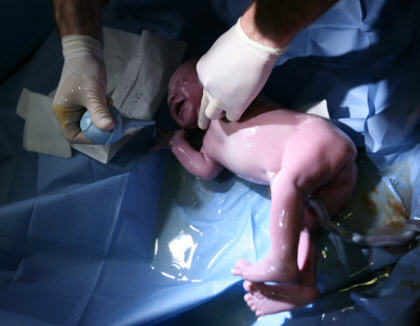 Последствия кесарева сечение