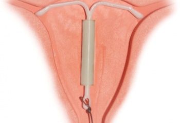 Внутриматочная спираль: ставить или нет?